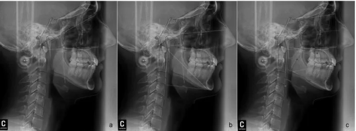 Fig. 1 Photographs of cephalometric standards used: (a) Adenoids analysis; (b) Rocabado Analysis; (c) Analysis of sleep apnea.