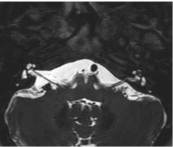 Fig. 3 T2, Low signal mass in the left apical turn of the cochlea.