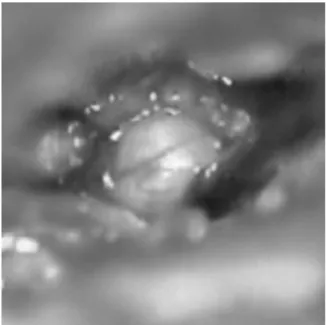 Fig. 4 Audiometry with bilateral sensorineural hearing loss, severe at the right side and profound at the left side.