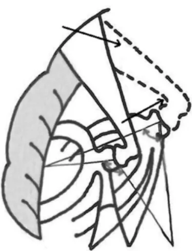 Fig. 2 Illustration showing change in angle due to obliquity of stapes in otosclerosis (dotted line).