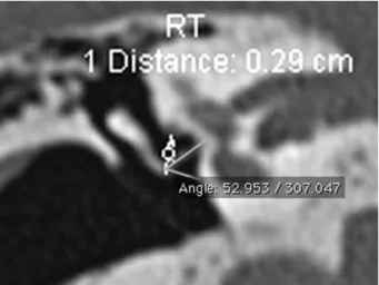 Fig. 4 HRCT Temporal bone coronal image showing angle measured in otosclerotic patient.