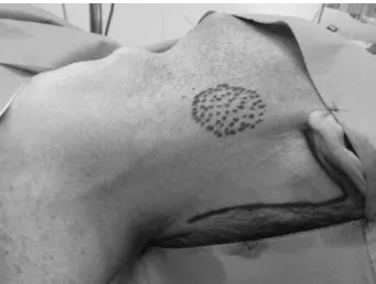 Fig. 1 Retroauricular incision planning.