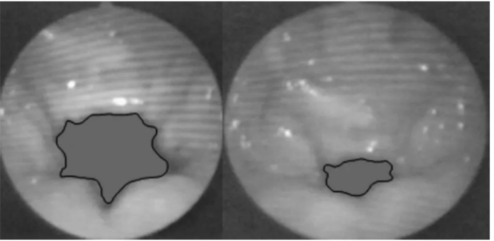 Fig. 1 VPS closure in modal register before and after vocal fry in one of the male subjects (increase in VPS closure ¼ 10.76cm 2 )