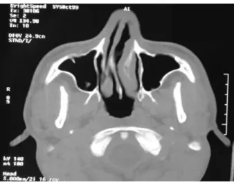 Fig. 2 Axial CT scan showing mucosal contact between the peak of septal spur and the right inferior nasal turbinate mucosa.