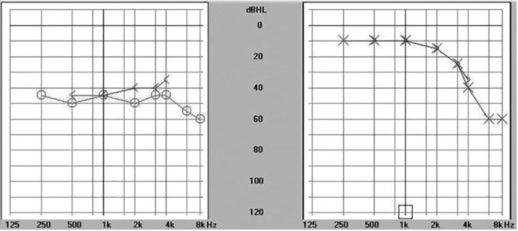 Fig. 1 Pure tone audiometry. Abbreviations: dBHL, decibels hearing levels; O, air conduction, right ear; X, air conduction, left ear; < , bone conduction, right ear; > , bone conduction, left ear.
