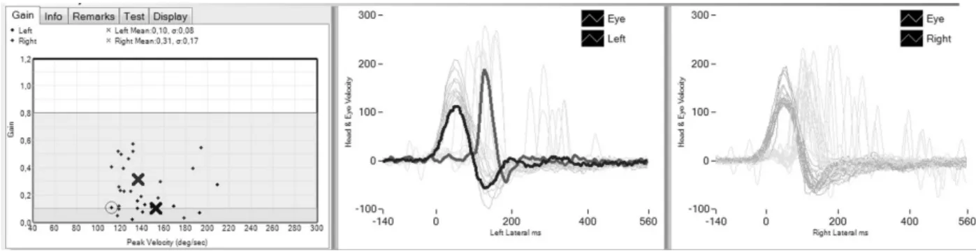 Fig. 3 Vestibulo-ocular re ﬂ exes of the left posterior and right anterior semicircular canals.