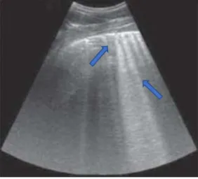 Figura 4: Imagem ecográfica de pleurite num torax equino. De notar a presença de artefatos regularmente  chamados de “caudas de cometa”(setas)