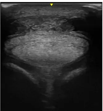 Figura  19  -  Região  3C  de  um  membro  anterior.  É  possível observar aderências entre o LAP e o TFDS  (imagem  ecográfica  gentilmente  cedida  pela  CVME)