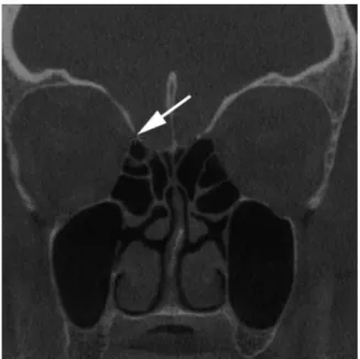 Fig. 2 Right ethmoidal foramen (arrow); Frontal beak (  ); Ethmoid bulla (þ).