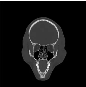 Fig. 2 Mucosal thickening.