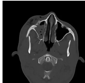 Fig. 5 Acute rhinosinusitis.