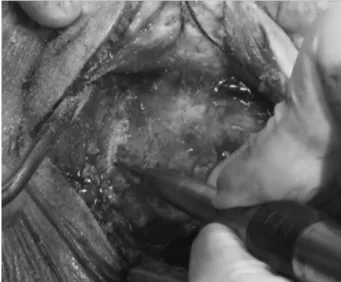 Fig. 5 Boring of the mastoid cortical bone in the “ U ” region.