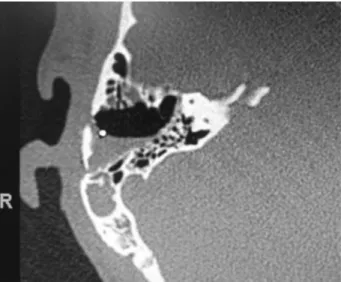 Fig. 11 Bone axial computed tomographic image obtained immedi- immedi-ately after surgery in a patient who underwent cochlear implant surgery with a ﬂ ap.