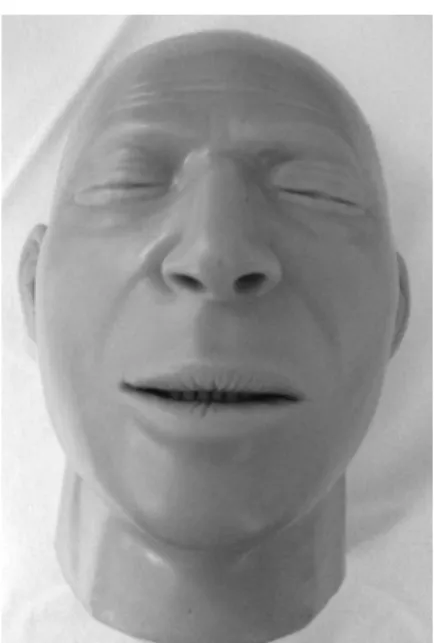 Fig. 3 Dilatation of right parotid papilla. Fig. 4 Dilatation of left submandibular papilla.