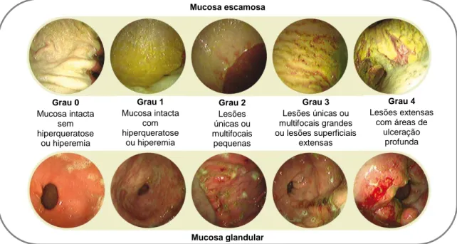 Figura 3 - Classificação EGUS consoante o grau de lesão; adaptado de: 