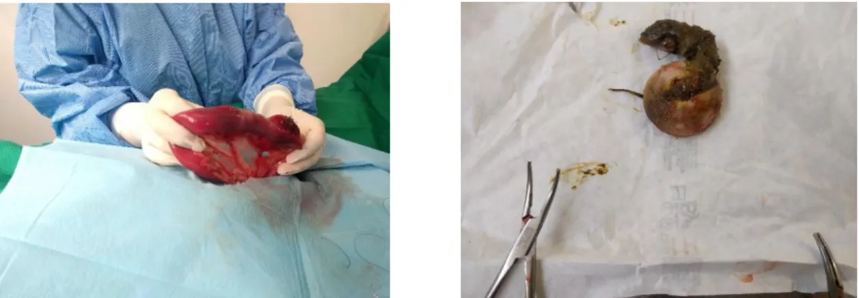 Figura 5 - Imagem representativa de uma enterotomia (à esquerda) para remoção de corpo  estranho (à direita), que acabou em enterectomia (imagem gentilmente cedida pelo HVUC).
