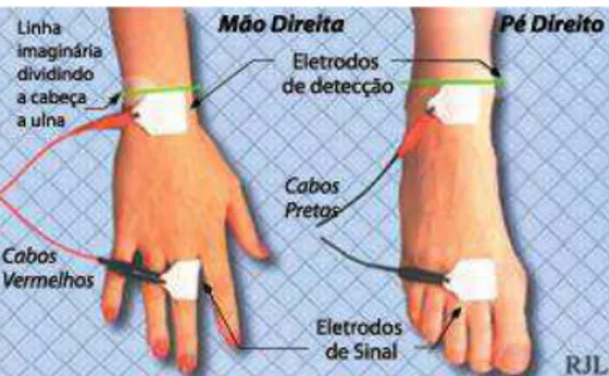 Figura 3. Posição para fixação de eletrodos nos pés e nas mãos para a análise de bioimpedanciometria