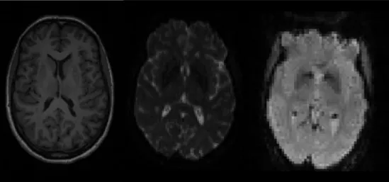 Figure 1.5: Examples of the three most commonly used MRI modalities. From left to right: structural T1-weighted imaging, diffusion weighted imaging and  func-tional imaging.
