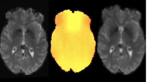 Figure 2.4: Example of susceptibility correction on functional MRI data by applying a field map