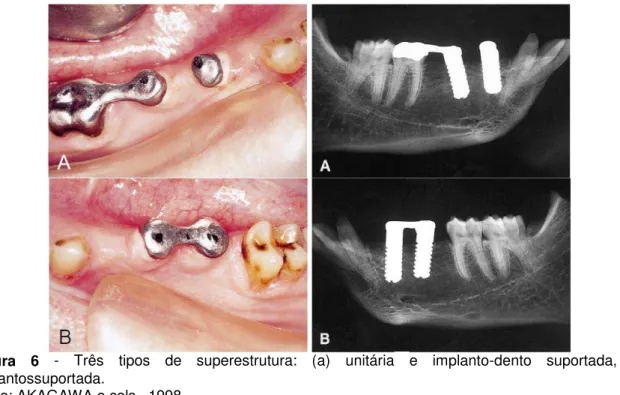 Figura  6  -  Três  tipos  de  superestrutura:  (a)  unitária  e  implanto-dento  suportada,  (b) 