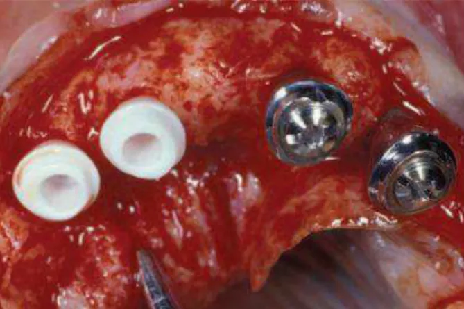 Figura 8  – Dois implantes de zircônia e dois implantes de titânio foram colocados.   Fonte: KOHAL e cols., 2004