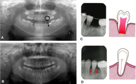 Figura  1  -  Autotransplante  dentário  de  um  pré-molar  devido  a  agenesia  congénita