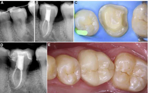 Figura 3 – Procedimento pós-autotransplante. A) Estabilização do dente autotransplantado B) Radiografia  apical do tratamento endodôntico C) Vista oclusal da preparação do dente dador D) 2 anos de follow-up  radiográfico E) 2 anos de follow-up clínico na r