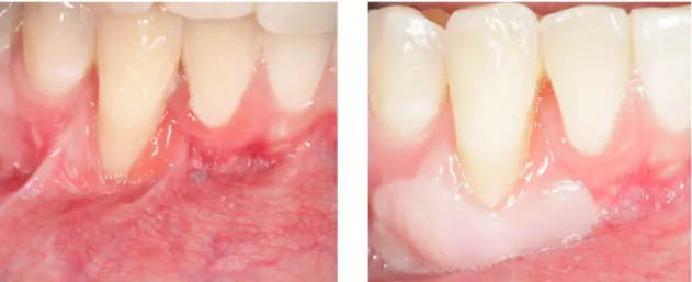 Figura 5: Fotografia da situação inicial (à esquerda) e aumento de faixa de gengiva queratinizada com  EGL (à direita) (Cortesia Dr