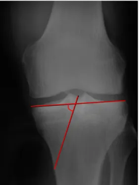 FIGURA  7  –  Radiografia  simples  do  joelho  esquerdo  mostra  a  análise  da  angulação no plano coronal do túnel tibial