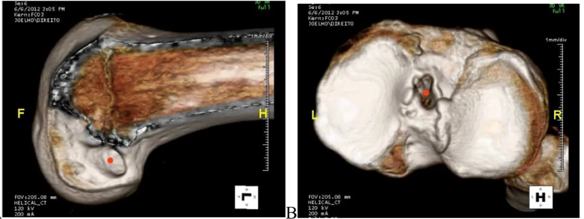 FIGURA  8  –  Imagens  tridimensionais  da  tomografia  computadorizada.  (A):  Imagem do fêmur direito com identificação do centro do túnel  femoral  (ponto  vermelho)