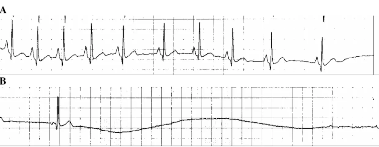 Figure 2 - Tilt table testing. After 8 minutes of 1.25 mg sublingual isosorbide dinitrate, the patient   developed a sudden and rapid slowing of heart rate, followed by a 6.4 seconds asystole, profound   hypotension, faint and seizure