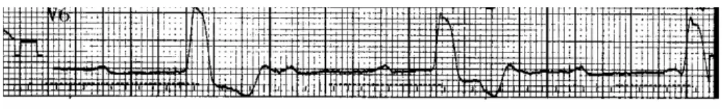 Figure 4 - ECG at admission in  emergency room after an episode of faint and  seizure