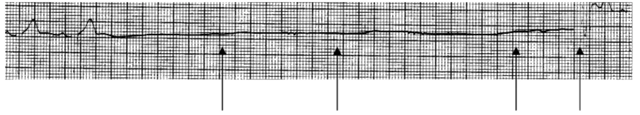 Figure 5 -  Right-sided  carotid  sinus  massage  with  a  6.08  seconds  sinus arrest 