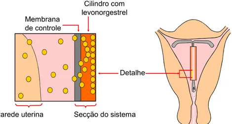 FIGURA 2 - Sistema intra-uterino de liberação de levonorgestrel. 