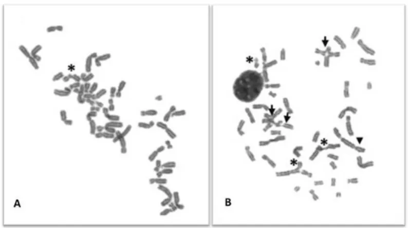 Figure 1.  CI pattern in metaphases from DEB- DEB-induced lymphocyte cultures from a healthy  donor and FA patient
