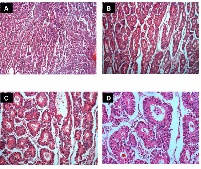 FIGURA 2 -  Fotomicrografias de adenocarcinoma endometrióide bem diferenciado  (G1) na classificação de FIGO corado por Hematoxilina e Eosina  