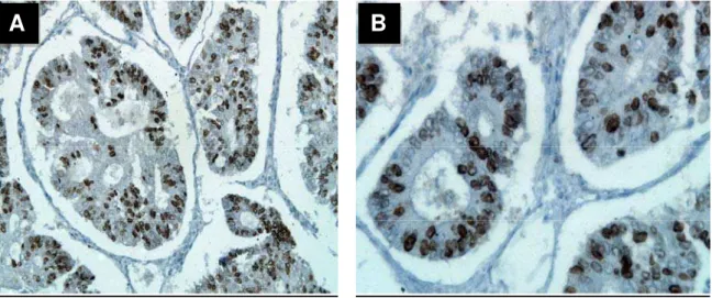 FIGURA 9 - Fotomicrografia de adenocarcinoma endometrial e expressão da  proteína ki-67 em 75% dos núcleos (IHQ)  