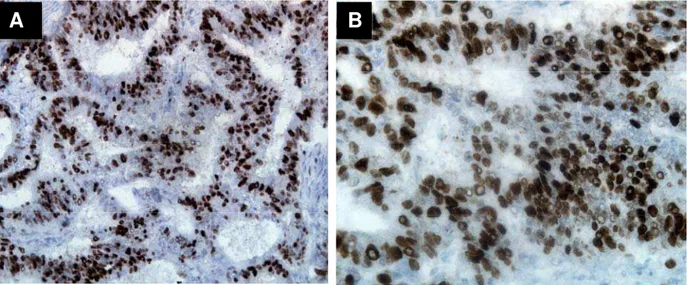 FIGURA 10 - Fotomicrografia de adenocarcinoma endometrial e expressão da  proteína ki-67 em 90% dos núcleos (IHQ)  