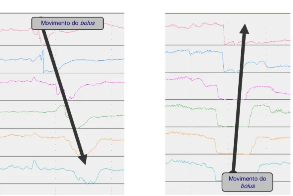 FIGURA 5 Registro de impedância mostrando o fluxo anterógrado do bolus  durante a deglutição e o fluxo retrógrado quando da ocorrência de refluxo