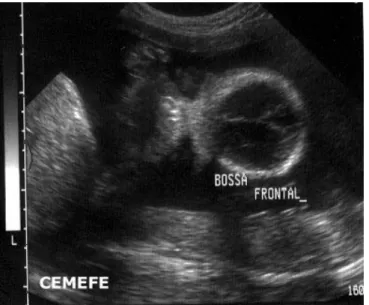 FIGURA  1-  US  mostrando:  fronte  proeminente  na  imagem  transversal  do  crânio  de  um  feto  com  diagnóstico  pré-natal  de  Displasia  Tanatofórica