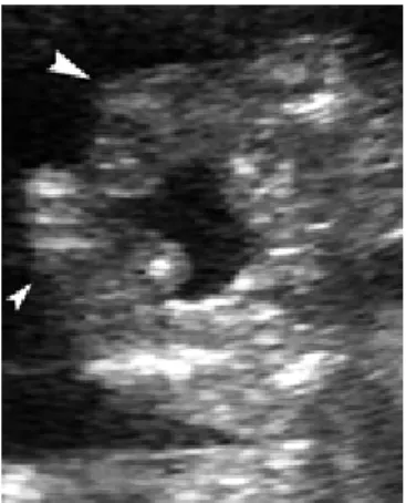 FIGURA  10-  Imagem  de  US  mostrando:  pé  torto  bilateral  na  displasia  diastrófica