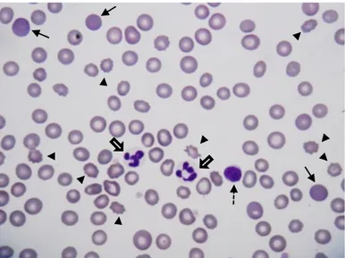 Figura 2- Esfregaço de sangue de canídeo. Presença de  policromatófilos  (setas  finas),  acantócitos  (pontas  de  setas),  neutrófilos  (setas  largas)  e  linfócito  (seta  a  tracejado)