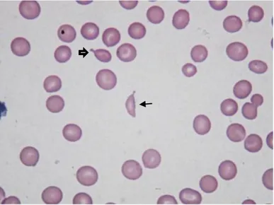 Figura 5- Esfregaço de sangue de canídeo. Presença de  esquizócito  (seta  fina)  e  dacriócito  (seta  larga)