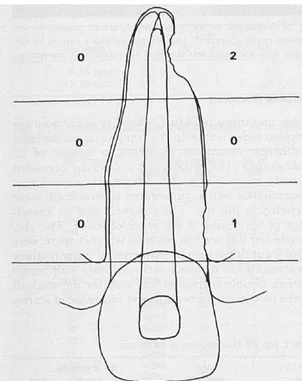 Figura  3:  Desenho  esquemático  do  critério  para  cálculo  do  índice  radiográfico  de  reabsorção:   Critérios  para  pontuação  da  profundidade  da  cavidade  de  reabsorção  a  partir  da 