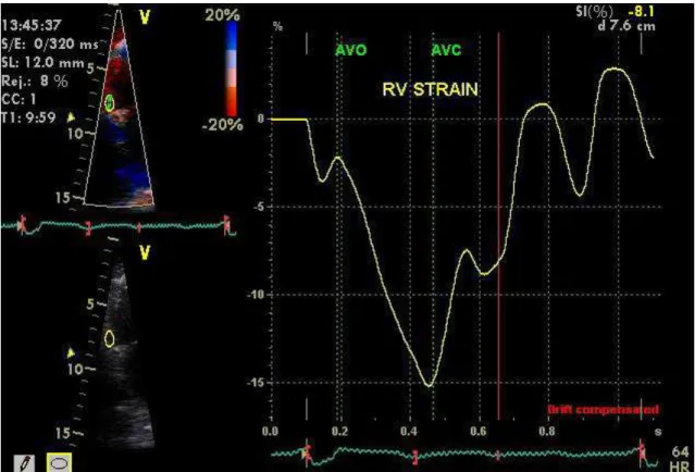 Figure 1: RV color Doppler myocardial imaging of peak systolic strain at its basal free  wall  in  the  apical  4-chamber  view;  narrowed  sector  enables  maximal  yield  in  frame  rate (ideally&gt;150/s), optimizing data acquisition