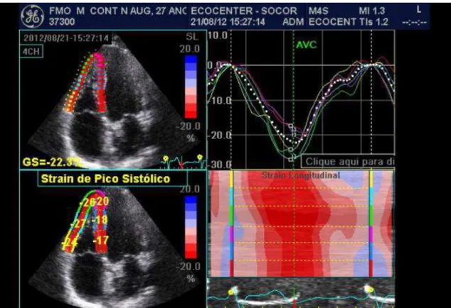 Figure 2: RV two-dimensional strain (speckle tracking) in a healthy patient in the apical  4-chamber  view