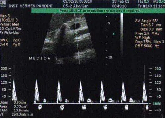 Figura 3. Espectro de fluxo da artéria mesentérica superior em paciente com volume de fluxo  normal