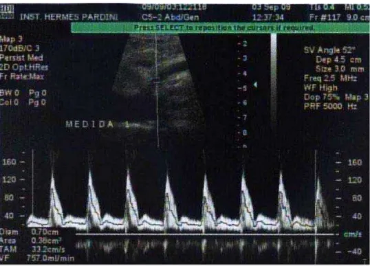 Figura 4. Espectro de fluxo da artéria mesentérica superior em paciente com volume de fluxo  aumentado