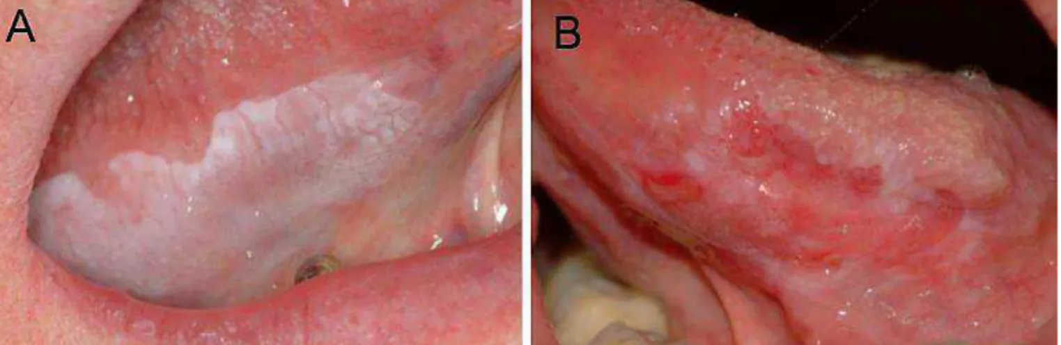 Figura 1 :  Aspecto clínico das leucoplasias bucais; A) Leucoplasia bucal homogênea em  borda lateral de língua; B) Leucoplasia bucal heterogênea em borda lateral de língua