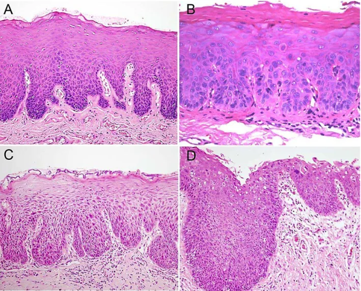 Figura 2:  Fotomicrografia de espécimes de LB; A) Displasia epitelial leve. As células  da  camada  basal  apresentam  atipia  citológica  incluindo  pleomorfismo  e  hipercromatismo  confinadas  à  camada  basal  e  para-basal